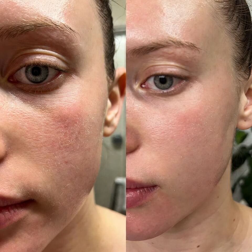 Side-by-side before-and-after: dry flaky cheek vs smoother hydrated skin.
